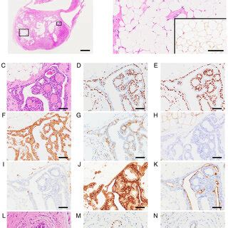 Histological And Immunohistochemical Features Of The Biopsy Specimen