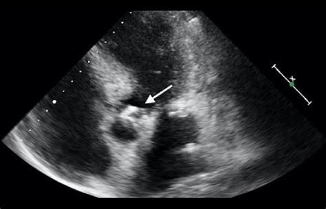 First Transthoracic Echocardiography Apical 5 Chamber View Showing