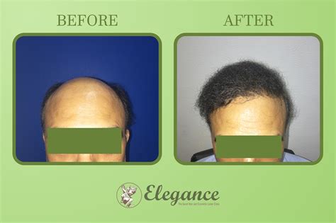 Hair Transplant Doctor Althan Surat Gujarat India