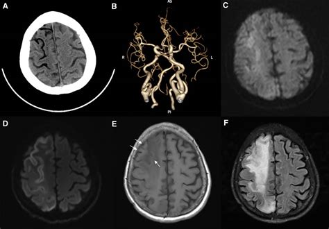 Stroke Aha Asa On Twitter Stroke Images Massive Cerebral Air