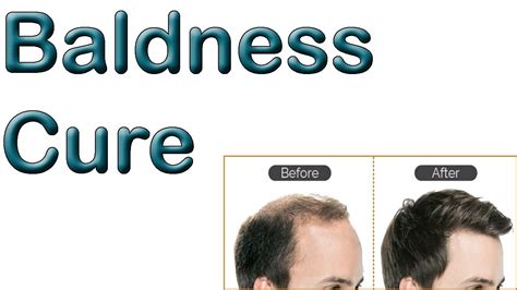 Baldness Cure 100 Natural Remedy To Cure Baldness Youtube