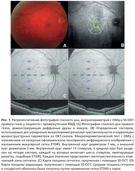Рис 1 Репрезентативная фотография глазного дна микропериметрия с ОМЦ