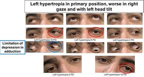 Fourth nerve palsy – Case-Based Neuro-Ophthalmology