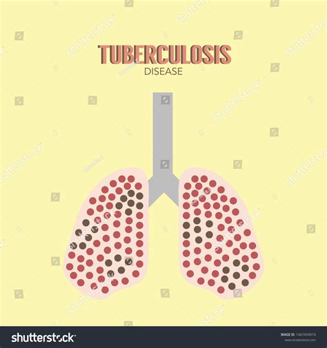 Lungs Infected Person Mycobacterium Tuberculosis Close Up Stock Vector