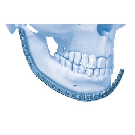 Placa de compresión mandíbula porción distal MatrixMANDIBLE