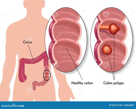 Colon Polyps Stock Vector Illustration Of Colonoscopy 28712739