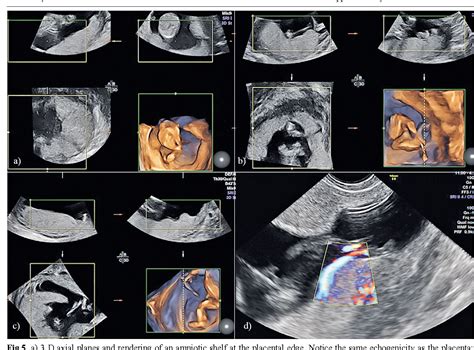 Placenta Circumvallate