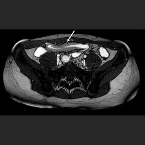 Mrt Darm Mrt Sellink Aristra Radiologie Netzwerk