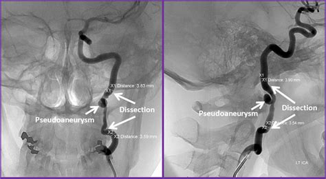 Arterial Dissection Carotid Vertebral Basilar Arteries Neuroangio Org