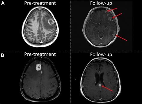 Focal Management Of Large Brain Metastases And Risk Of Leptomeningeal