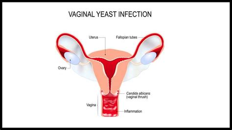 Cottage Cheese Vaginal Discharge Causes Symptoms And Treatment