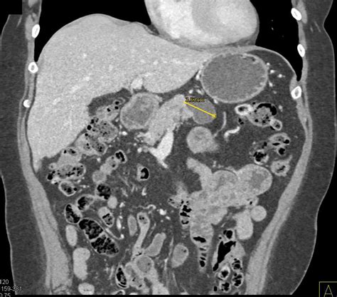 Metastatic Renal Cell Carcinoma With Pancreatic Metastases Kidney