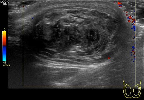 Bilateral Testicular Epidermoid Cysts In A Man With Klinefelter