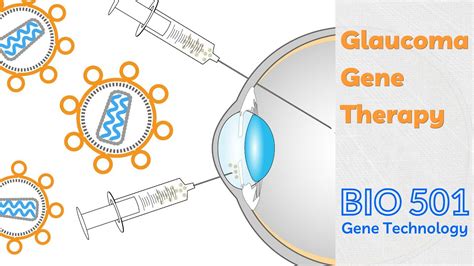 Glaucoma Gene Therapy Possible But Not Any Time Soon Youtube