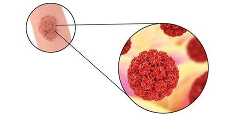 Kondiloma Akuminata Pada Wanita Yang Berbahaya Vena Wasir