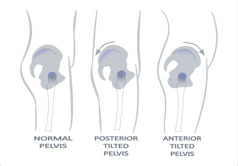 What is Anterior and Posterior Pelvic Tilt - RJM Therapy