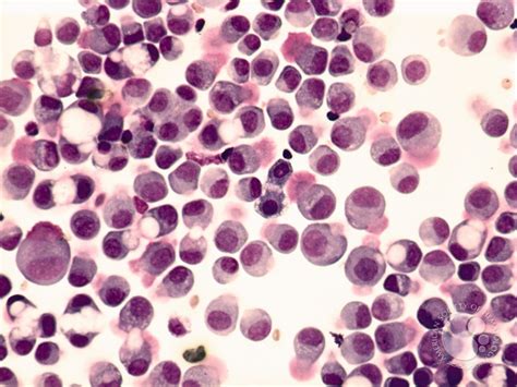 Peritoneal Fluid Extrinsic Cells 1