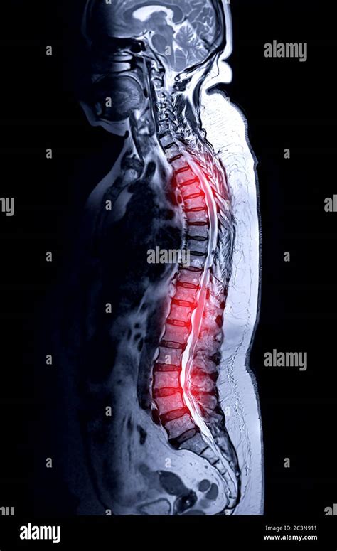 Examen IRM de la colonne vertébrale entière pour le diagnostic de la ...