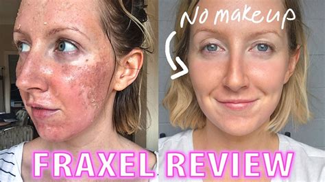 Fraxel Acne Scars Before And After