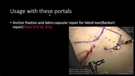 Shoulder Portal Posterolateral Additional Portal Youtube