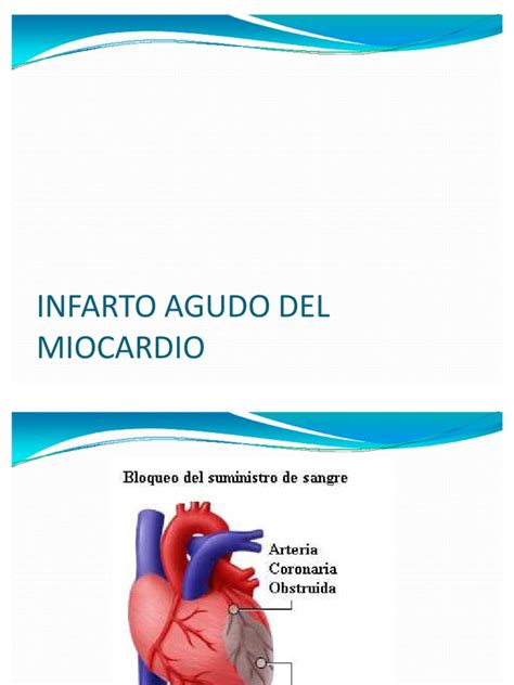 Infarto Agudo Del Miocardio Power Point