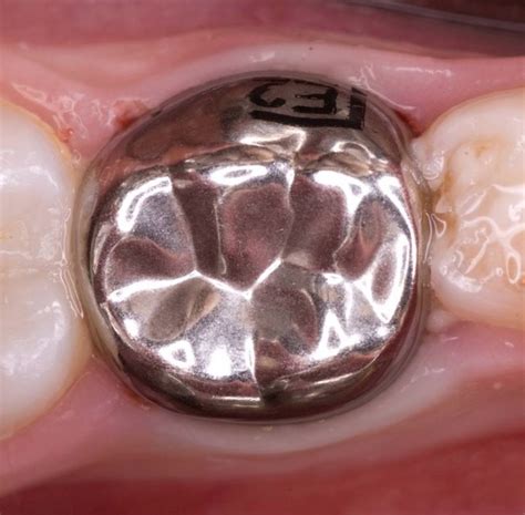 Preformed Metal Crown On Primary Molars Conventional Or Hall