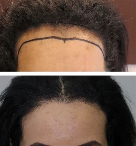 Hairline Lowering With Hair Transplant Belorens