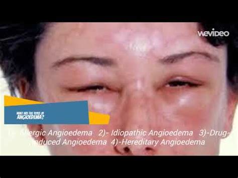 Angioedema - TYPES - YouTube