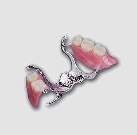 Metal-Dentures | Denture 4 You