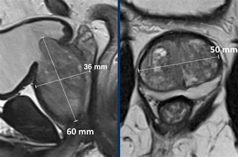 The Radiology Assistant Prostate Cancer Pi Rads V2 1