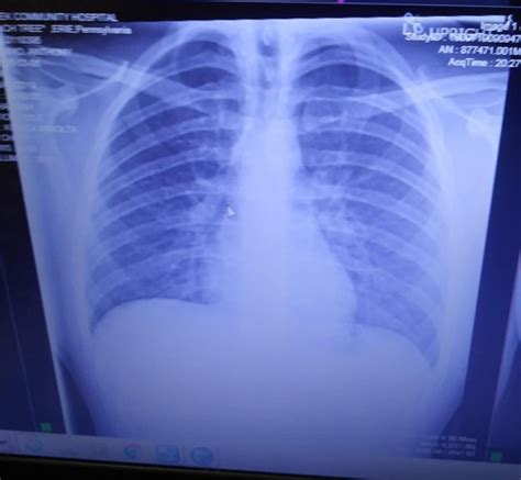 X-ray shows how vaping left teen's lungs caked with hardened oil ...