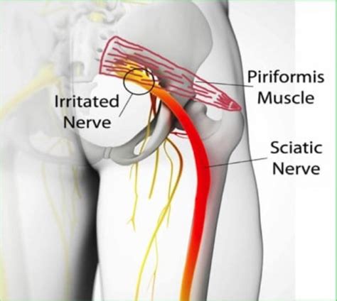 Piriformis Syndrome Sports Massage SB Santa Barbara Goleta Ca The