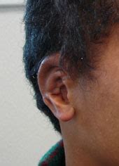 Cartilage Prominent Ears Ear Pinning Surgery