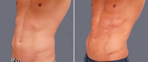 Vaser Hi Def Liposuction Sydney Gold Coast Canberra Adelaide