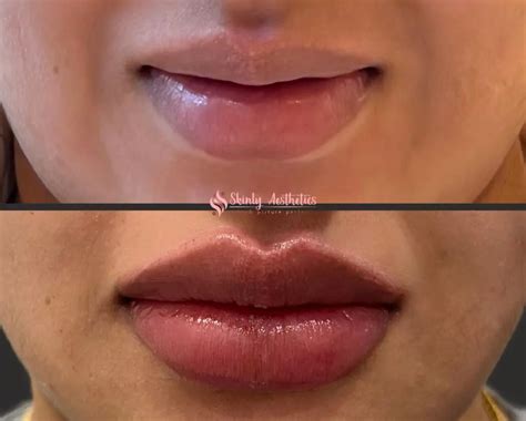 Russian Lip Filler Nyc S Top Choice For Fuller Heart Shaped Lips