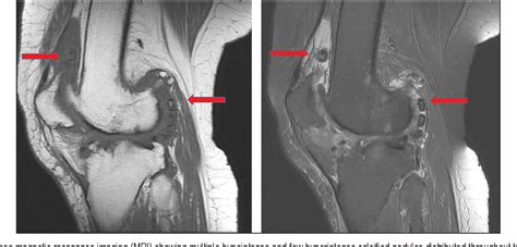 Figure From Bilateral Synovial Chondromatosis Of Knee Joint In A