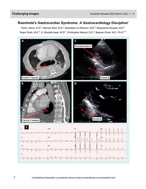 Pdf Roemhelds Gastrocardiac Syndrome A Gastrocardiology Discipline