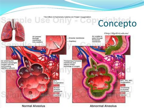 Ppt Esclerosis Vascular Embolia Pulmonar Hipertensión Pulmonar Edema Pulmonar Powerpoint