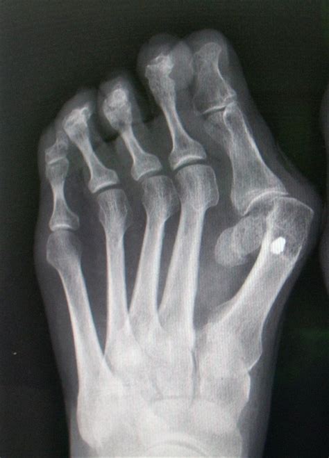 Hallux Valgus Foot Ankle Orthobullets