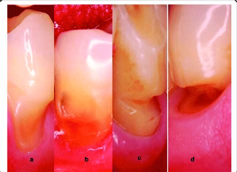 Abfraction Causes NCCL Causes NCCL Treatment Bauer Smiles 45 OFF