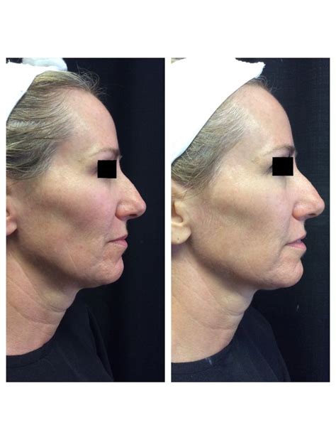 Ultherapy Before And After Of The Lower Face And Neck After 90 Days