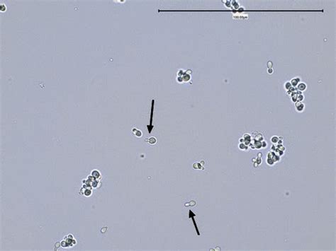 Tinea Versicolor Caused By Malassezia Furfur Infection And Laboratory Diagnosis Medical