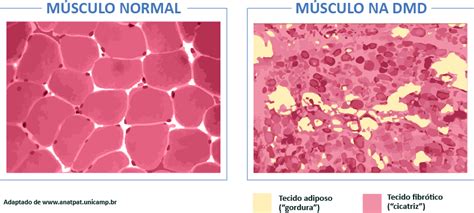 O Que É Distrofia Muscular De Duchenne - O que é Distrofia Muscular de Duchenne (DMD)? - Movimento Duchenne
