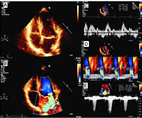 Prolapso valvular mitral y regurgitación moderada a severa A Vista