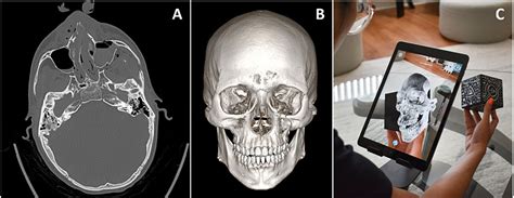 Empowering Surgeons With Augmented Reality Sira Medical S Breakthrough