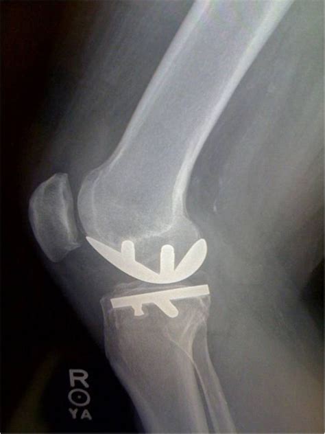 Knee Prostheses Unicompartmental Interpositional Orthopaediclist