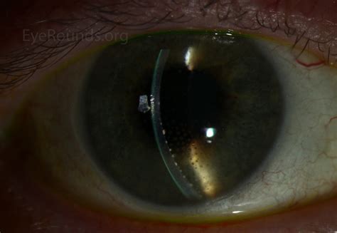 Atlas Entry - Mutton-Fat Keratic Precipitates (KP)