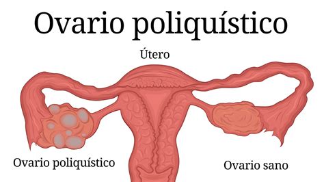 Todo Lo Que Tienes Que Saber Del S Ndrome De Ovario Poliqu Stico