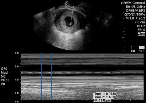 Fetal Heart Bcpocus