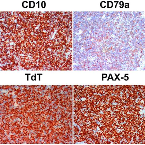 Histological Examination Of The Cervical Lymph Node Biopsy Of The Left Download Scientific